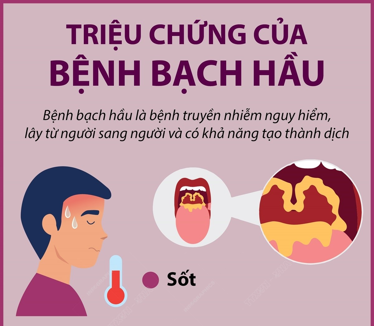 Triệu chứng của bệnh bạch hầu
