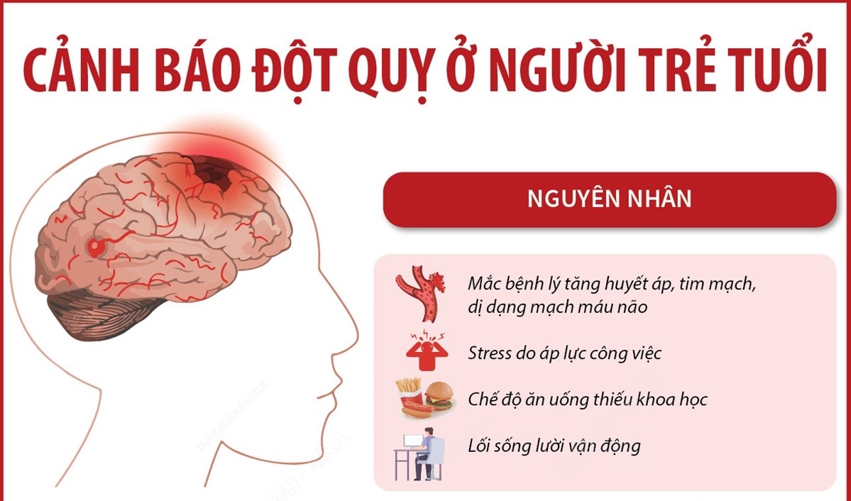 Cảnh báo đột quỵ ở người trẻ tuổi