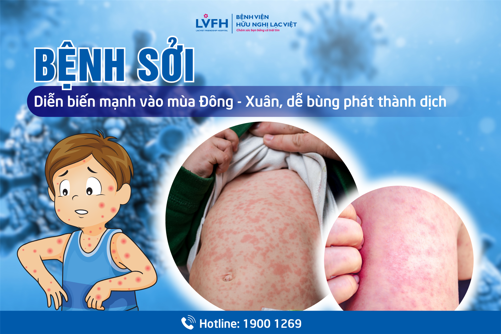 6 khuyến cáo phòng chống bệnh sởi
